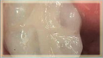 Amalgram to Composite Fillings - After