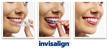 Woman wearing orthodontic silicone trainer. Invisalign - invisible braces aligner. Dental correction in Springfield Lorton Dental Group.