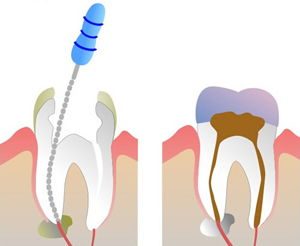 An illustration of root canal treatment. Springfield Lorton Dental Group performs root canal treatment with the highest level of expertise.