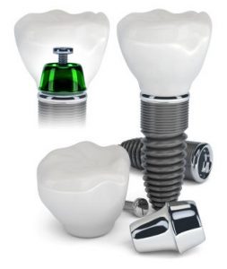 A graphic of a dental implant construction. Artifical tooth replacements in Springfield, VA.