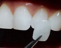 Photo of dental veneers - great aesthetic solution available in Springfield, Lorton, VA.