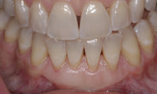 after gum grafting