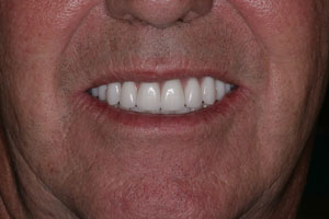 after Dentures