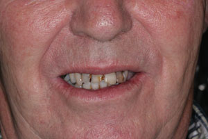 before Dentures