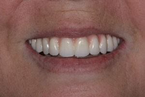 after Full arch Implant