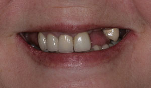 before Full arch Implant