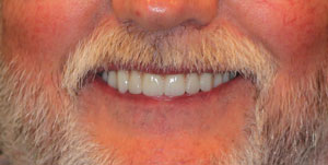 after Full arch implant bridge 