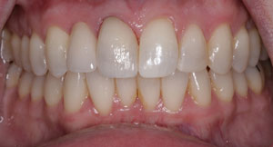 after Single Implant and crown