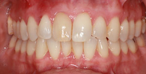 before Single Implant and crown