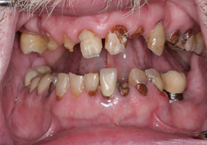 before Upper and Lower implant Fixed Bridges